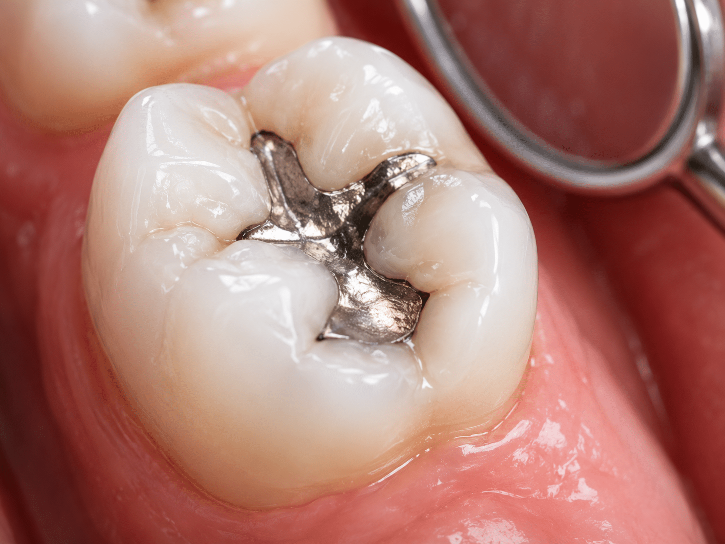 Dental filling
